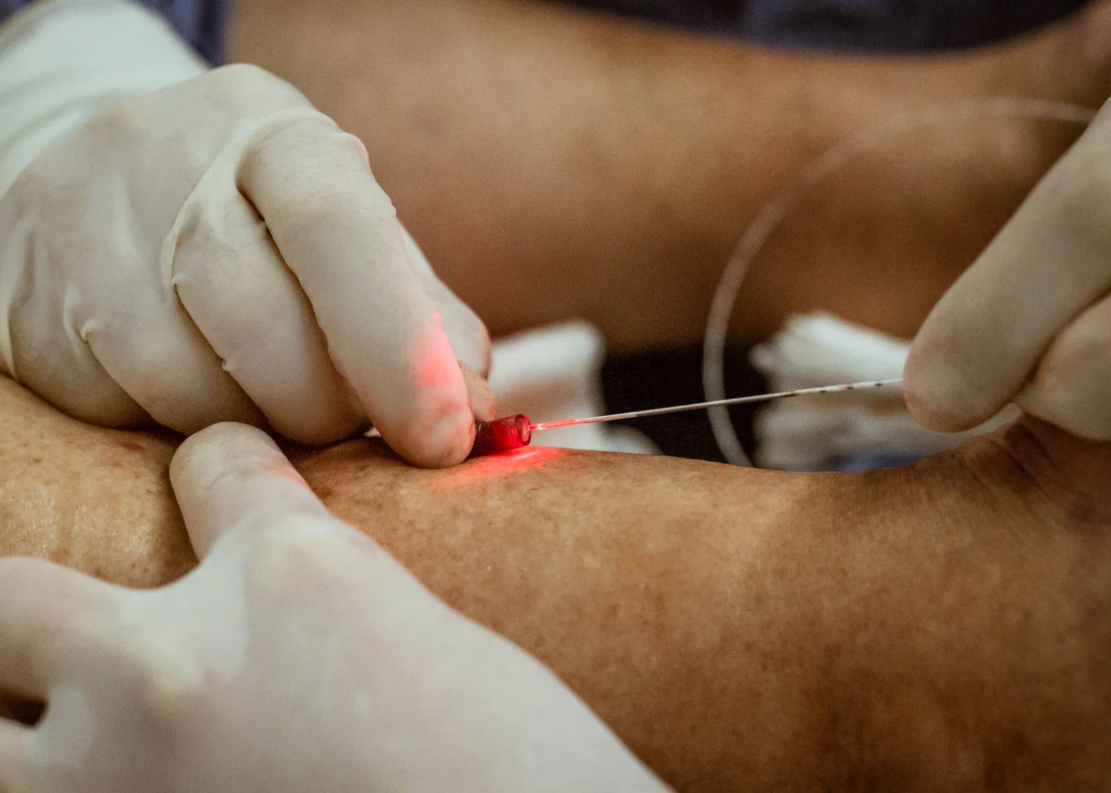 Fibra de laser usada no endolaser, guiada até a veia